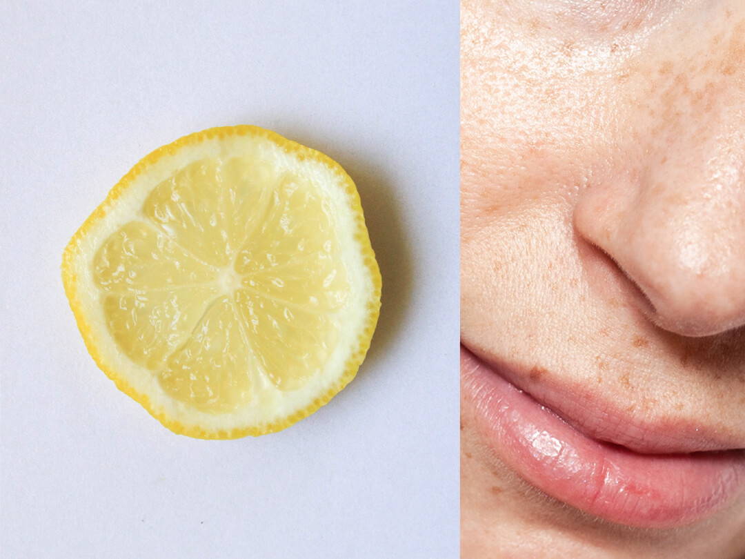Auf natürliche Weise im Gesicht Pigmentflecken entfernen: 5 effektive Tipps für ebenmäßige Haut